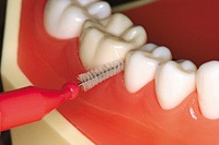 歯周治療の目的と方法